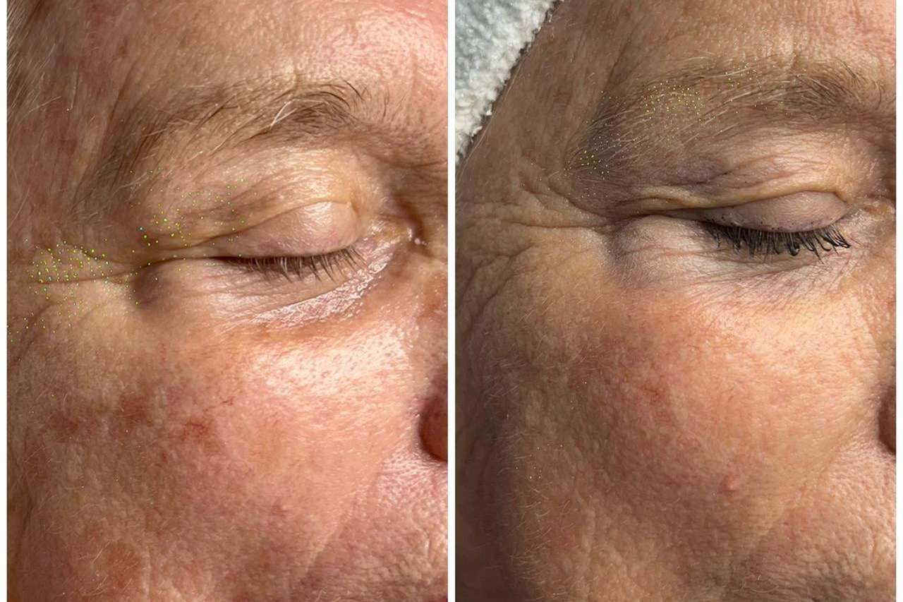 Antes y despues