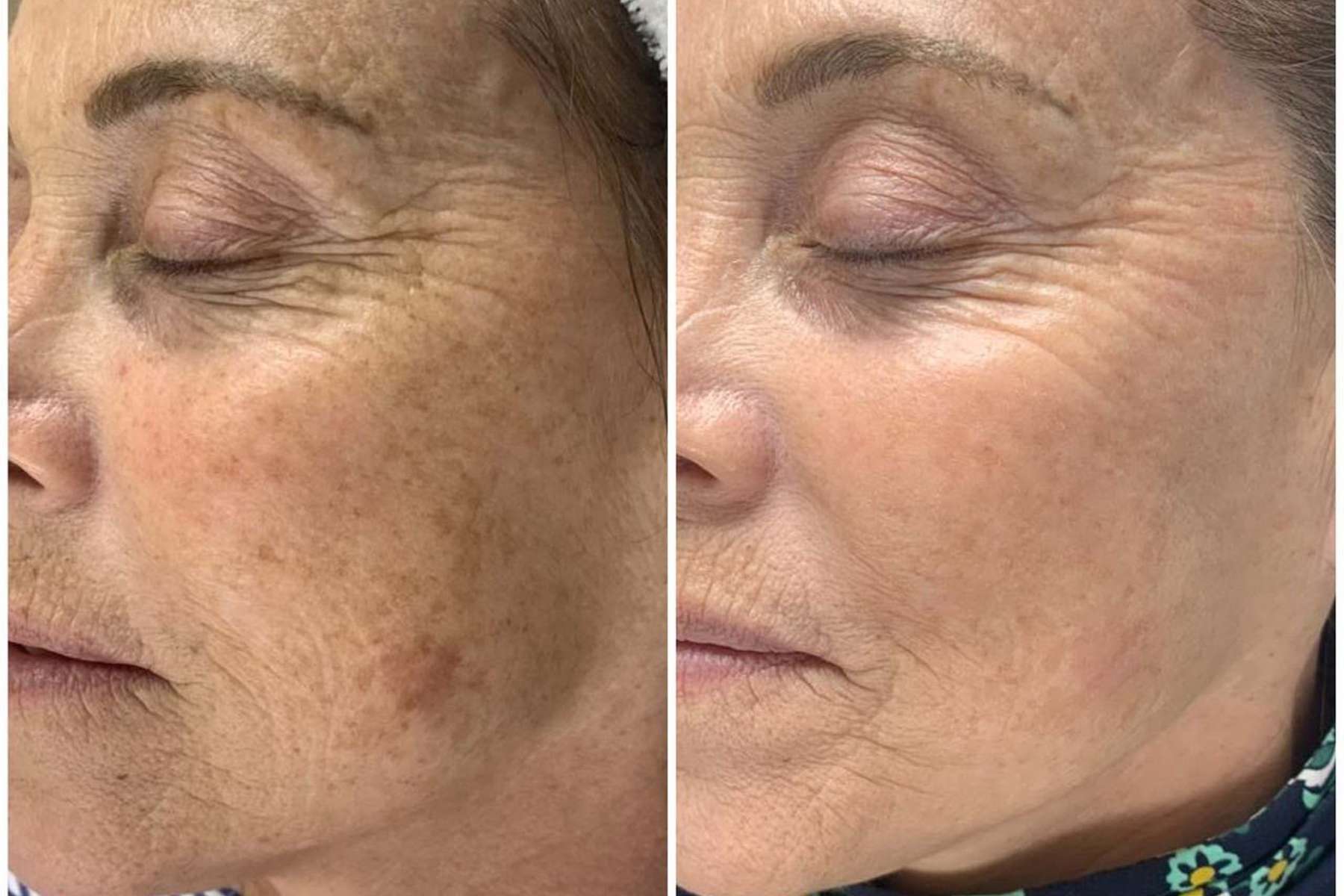 Antes y despues