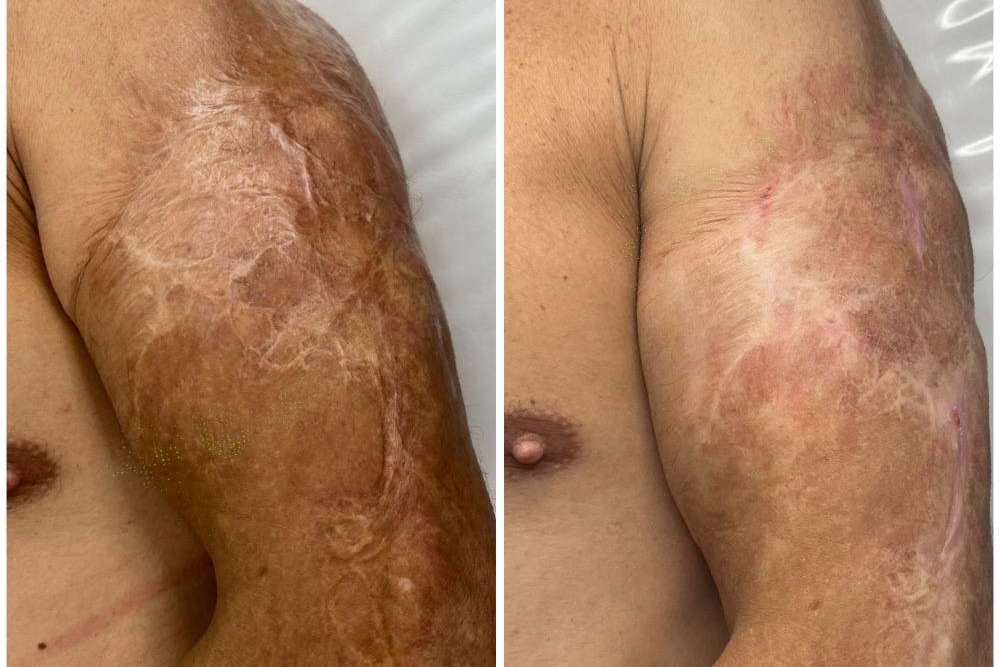 Antes y despues