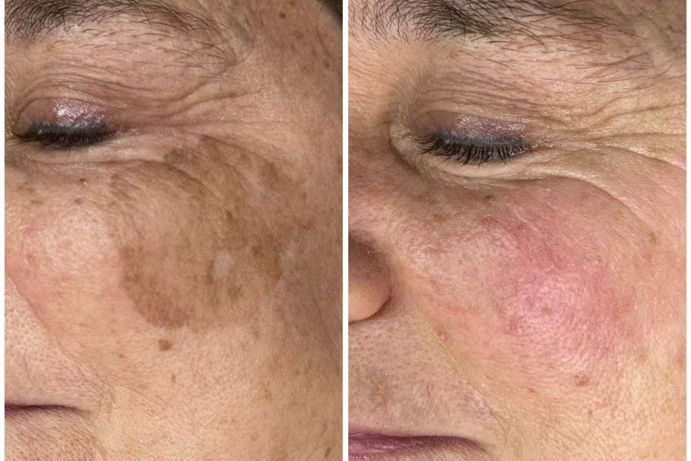 Antes y despues