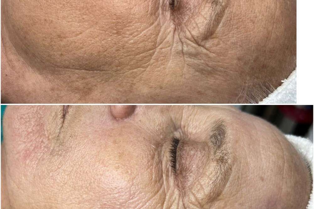Antes y despues