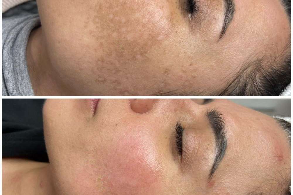Antes y despues