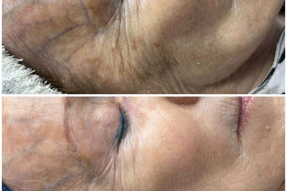 Antes y despues