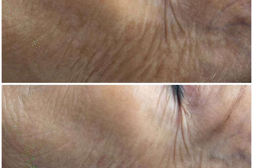 Antes y despues
