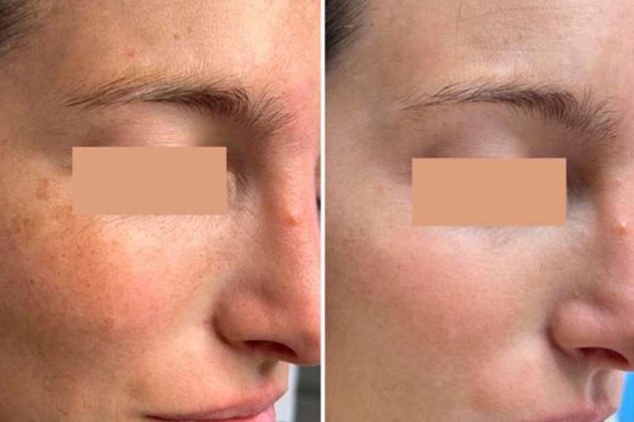 Antes y despues